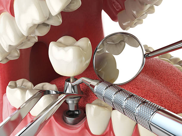 Best Emergency Broken Tooth Repair in Valparaiso, IN